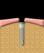 L’implant est inséré dans la mâchoire