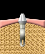 Un pilier est fixé à l’implant